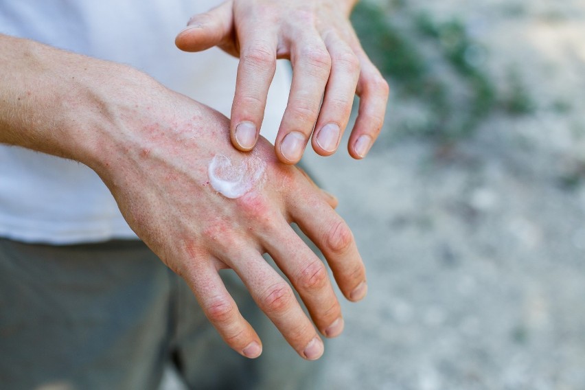 Częste mycie i dezynfekcja mogą powodować wysuszenie skóry...