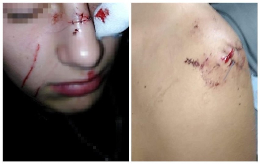 Dolny Śląsk. 15-latka pocięła zbitą butelką dwie inne nastolatki. Zobacz zdjęcia
