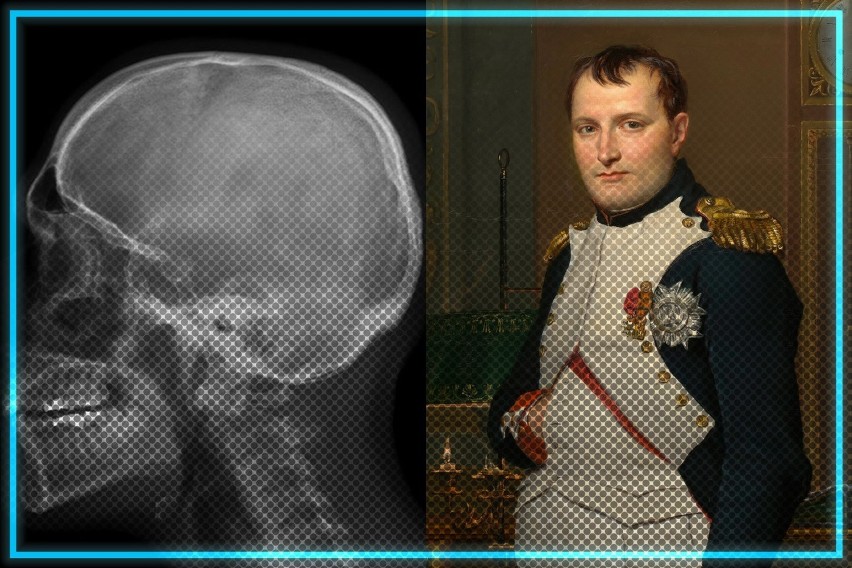 Naukowcy odkryli w czaszce Napoleona Bonaparte obiekt o...