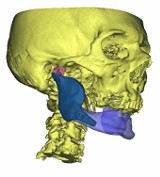 Indywidualny implant wydrukowany w drukarce 3D