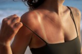 Jak szybko złagodzić oparzenia słoneczne? Zobacz najlepsze domowe sposoby na czerwoną skórę, ból i bąble po opalaniu