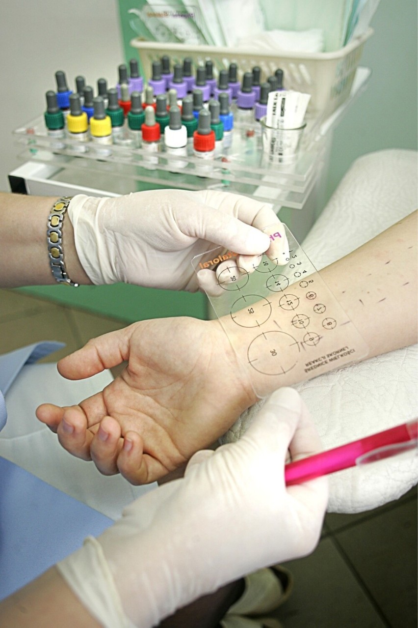 Testy skórne są najprostszą metodą potwierdzenia alergii.