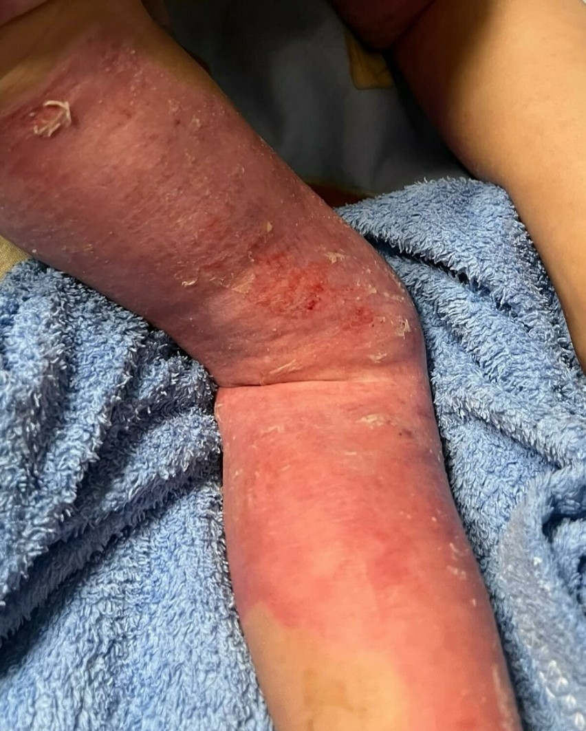 Dwuletnia dziewczynka poparzona chemicznie w przedszkolu....