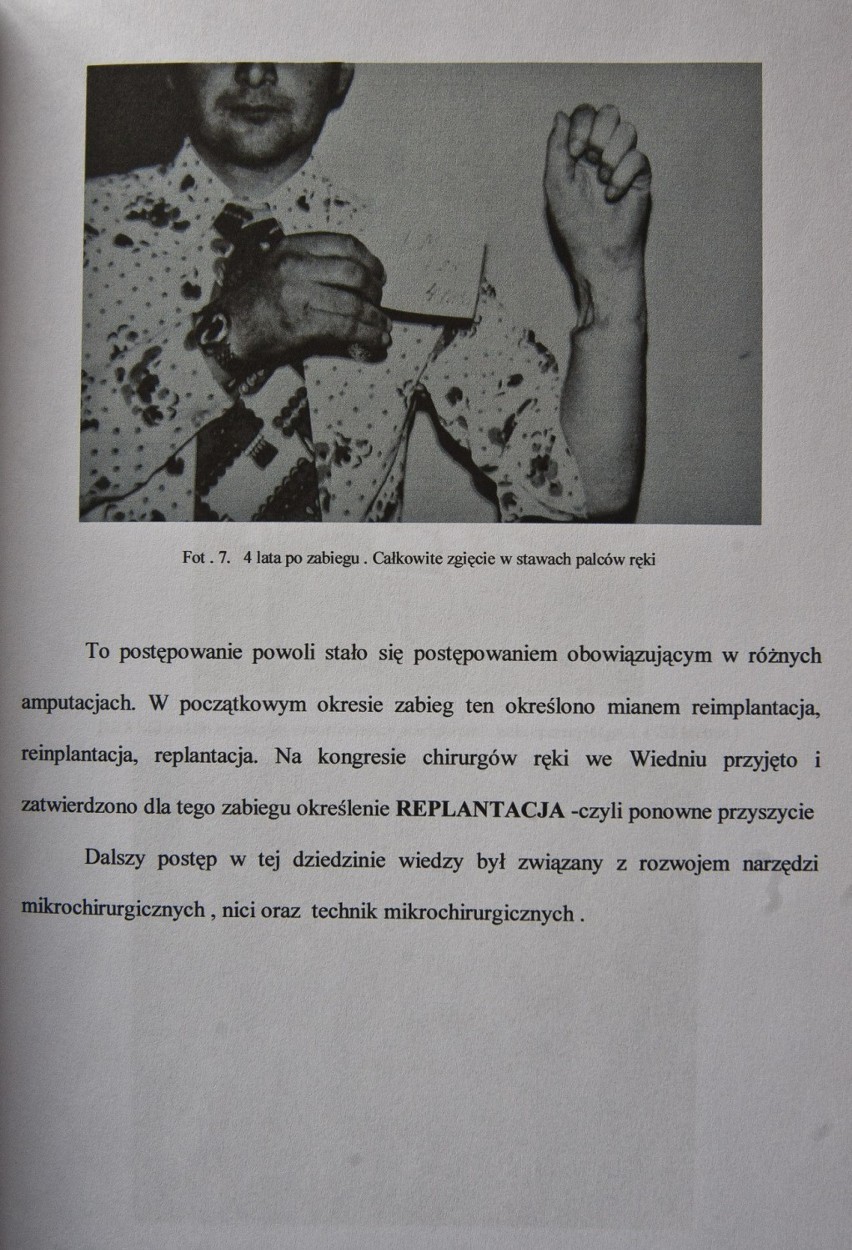 Józef Maszkiewicz pokazuje rękę przyszytą przez chirurgów w...