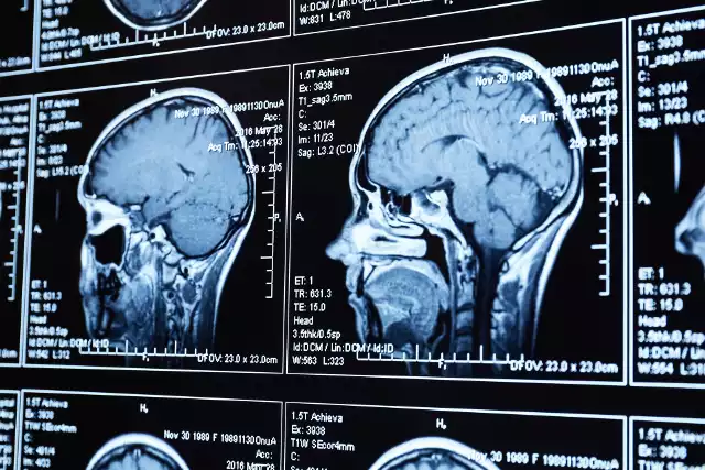 Niecodziennego odkrycia dokonali rosyjscy lekarze podczas tomografii komputerowej mózgu 80-letniej pacjentki. Zdjęcie ilustracyjne