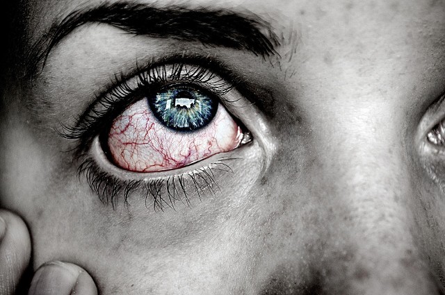 Nie ma wątpliwości, że przekrwione oczy nie należą do najatrakcyjniejszych wizualnie elementów naszego wyglądu. Jednak należy pamiętać o tym, że przede wszystkim świadczą one o tym, że w obrębie gałki ocznej dzieje się coś wyraźnie niedobrego. Wśród popularnych źródeł problemu wyróżnia się alergie, jednak czerwone oczy już od samego rana mogą świadczyć m.in. o zapaleniu spojówek lub o zespole czerwonego oka. Jak prawidłowo zadbać o oczy? Jak rozpoznać przyczynę przekrwienia oczu?SZCZEGÓŁY NA KOLEJNYCH STRONACH >>>>