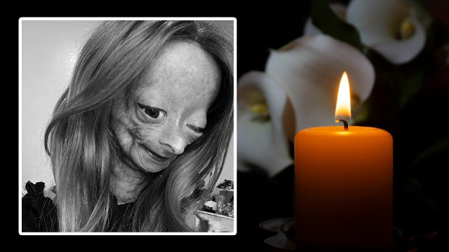 Adalia Rose Williams cierpiała na nieuleczalną chorobę, zespół progerii Hutchinsona-Gilforda.