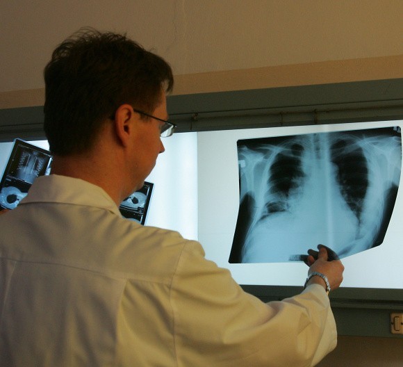 Do przeszczepu kwalifikują się m.in. osoby w schyłkowym stadium rozedmy płuc, z mukowiscydozą oraz włóknieniem płuc.