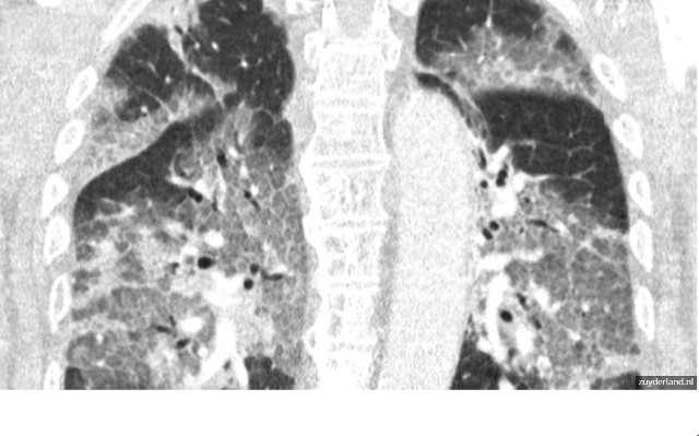 Holenderskie Centrum Medyczne Zuyderland opublikowało zdjęcie rentgenowskie płuc pacjenta z Covid-19. Ku przestrodze. Zobaczcie na zdjęciach jak dramatyczny jest ich stan po przejściu koronawirusa!WIĘCEJ NA KOLEJNYCH STRONACH>>>