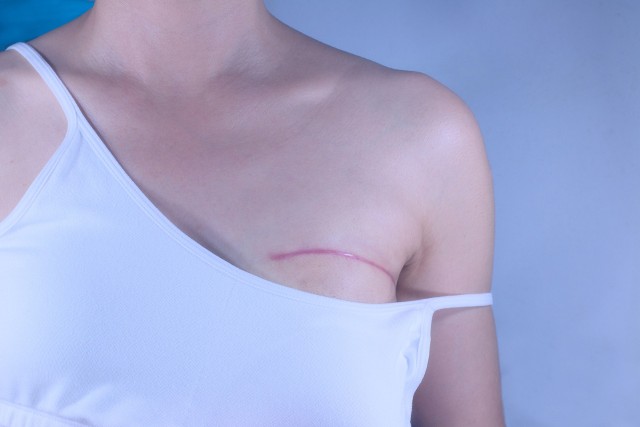Leczenie raka piersi metodą operacyjną polega na amputacji piersi (mastektomii). Jest ona stosowana w sytuacji, gdy nowotwór zajął większy obszar niż ćwiartka piersi.