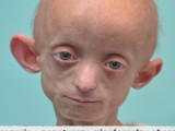 Ma 11 lat,a wygląda na 80. Ashanti cierpi na progerię
