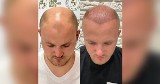 Mikropigmentacja skóry głowy i przeszczep włosów- trwałe nieinwazyjne i skuteczne sposoby na odzyskanie utraconych włosów