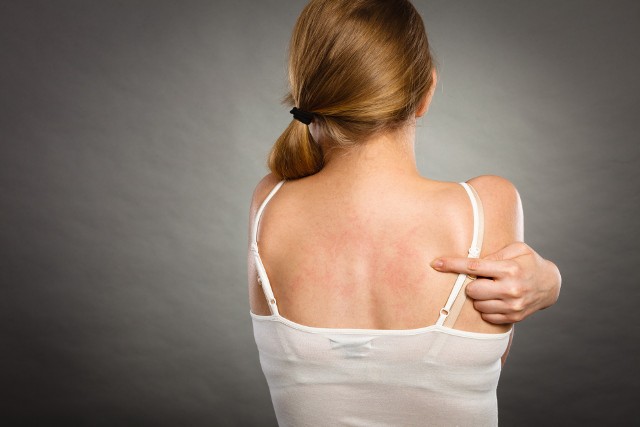 Łojotokowe zapalenie skóry jest dolegliwością objawiającą się występowaniem rumieniowatych plam na skórze.