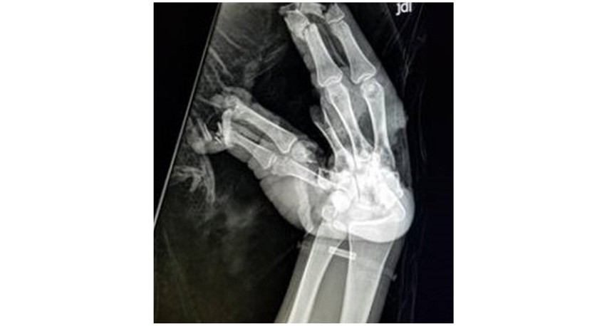 Zdjęcia RTG dłoni osób, którym petardy wybuchły w rękach