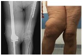 Nowe biodro, kolano i udo. Wystarczyła jedna operacja by ortopedzi z USK pomogli cierpiącej kobiecie