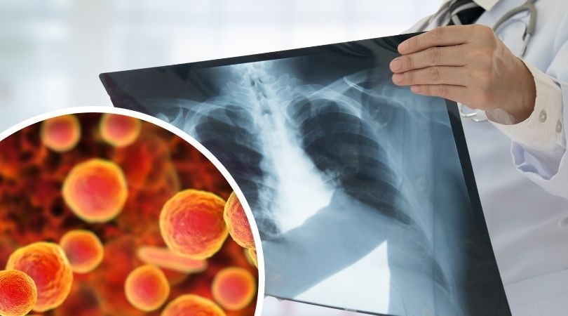 Bakteria Mycoplasma pneumoniae często przyczyniają się do...