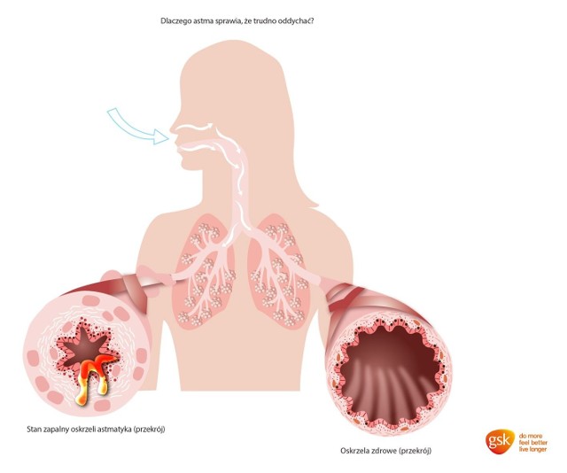 Dlaczego astma sprawia, że trudno oddychać?