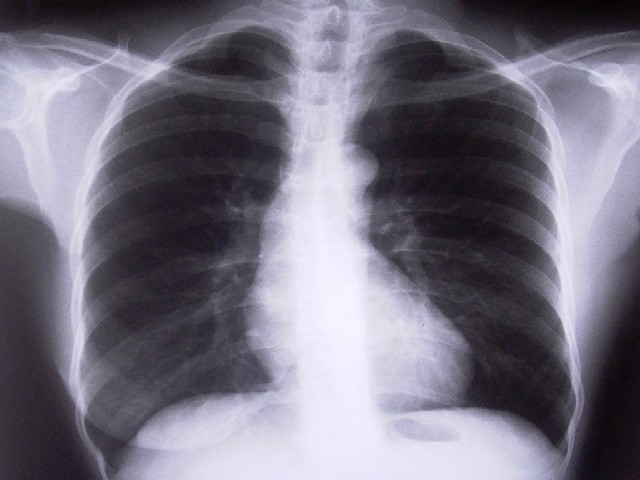w Polsce rak płuca diagnozowany jest u ponad 20 tys. osób rocznie