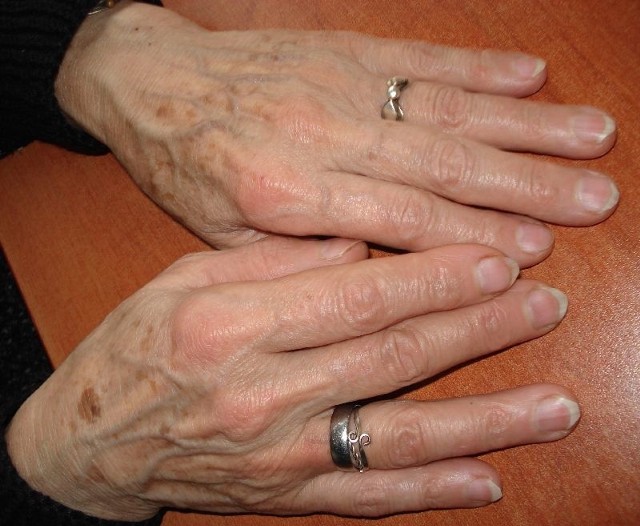 Zwykle jednym z pierwszych symptomów choroby Parkinsona bywa drżenie ręki &#8211; najczęściej jednej.