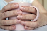 O czym świadczą białe plamy na paznokciach? Powody mogą cię zaskoczyć. Na liście m.in. manicure i leki