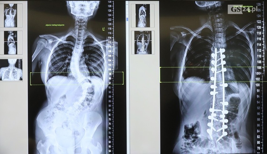 Zdroje: Nowatorska operacja kręgosłupa uratowała Natalii zdrowie i sprawiła, że urosła