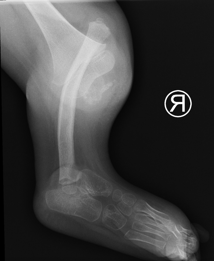 Zdjęcie rentgenowskie przedstawiające nogę dziewczynki przed...