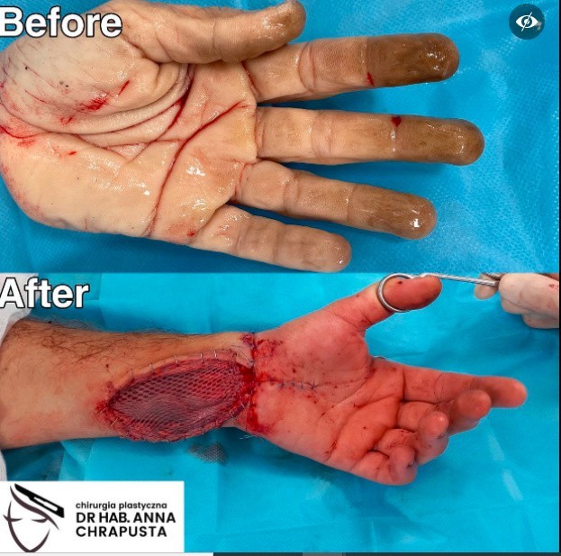 Ręka przed i po, operacja została przeprowadzono w środę w...