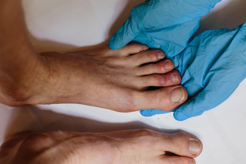 Grzybica paznokci u stóp jest znacznie częściej diagnozowana...