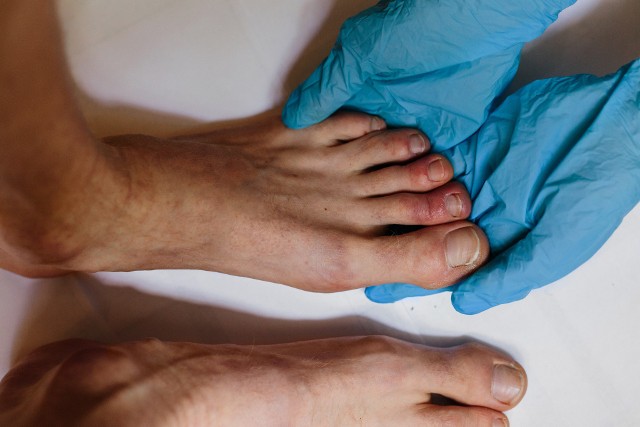 Grzybica paznokci u stóp jest znacznie częściej diagnozowana niż grzybica paznokci u rąk.