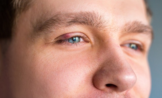 Niezależnie od przyczyny opuchlizna powieki zagraża zdrowiu oka, dlatego trzeba jak najszybciej ją leczyć.