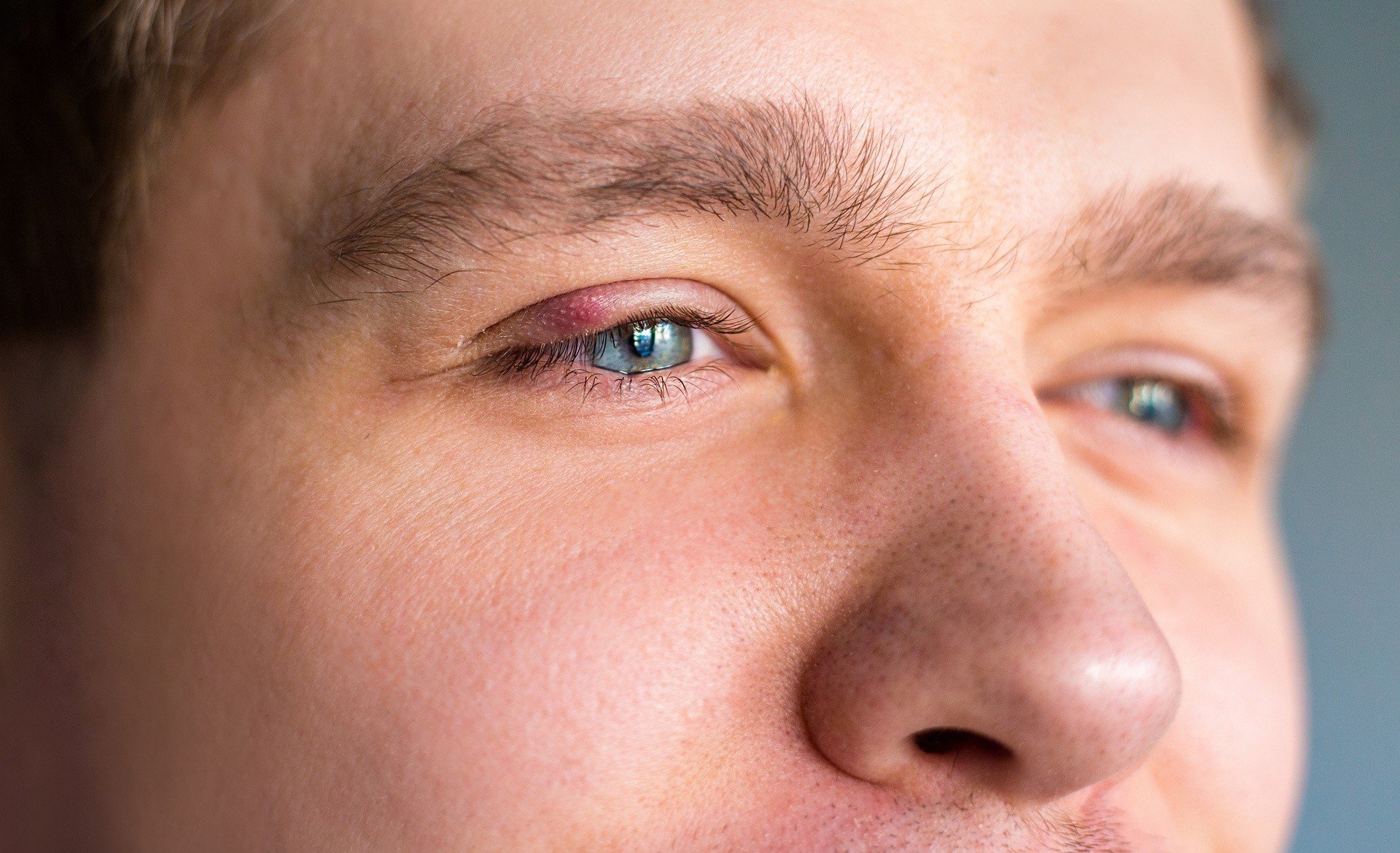 Na jaki problem wskazuje spuchnięta powieka? Kiedy można leczyć spuchnięte  oko domowymi sposobami, a kiedy konieczna jest wizyta u okulisty? | Strona  Zdrowia