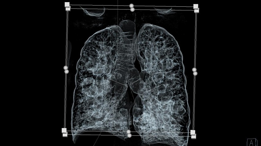 Zabrze. Drugie na świecie przeszczepienie płuc u pacjenta z zespołem Mounier-Kuhna 