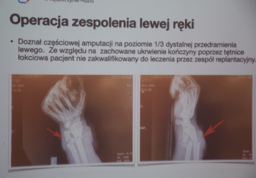 Cztery piąte obwodu ręki zostało przecięte. Po...