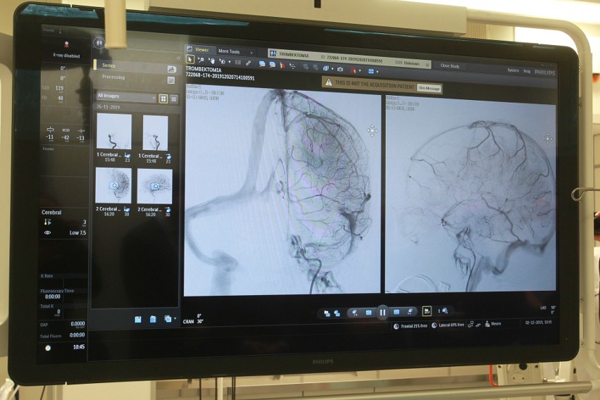 Nowoczesny angiograf pomaga w leczeniu udarów. Jest  w szpitalu przy ul. Lwowskiej w Rzeszowie  [ZDJĘCIA]