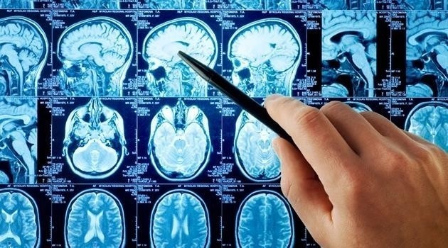 Stwardnienie rozsiane (łac. sclerosis multiplex - SM). Ta nieuleczalna choroba neurologiczna o nieznanym pochodzeniu dotyka w Polsce wiele tysięcy osób. Należy do tzw. chorób autoimmunologicznych. Na SM tak naprawdę może zachorować każdy. Jakie objawy powinny nas zaniepokoić?>>>>>>>>>CZYTAJ DALEJ