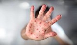 Czy Wielkopolsce grozi epidemia odry? Odnotowano kolejny wzrost zachorowań na odrę w całym kraju.