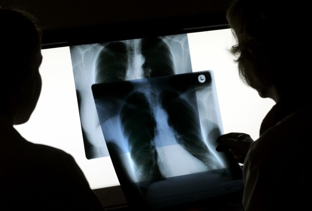 Działacze wrocławskiej Fundacji Rosa skoncentrują się m.in. na raku płuc