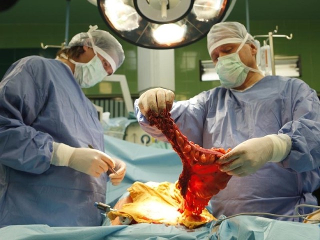 Usuniecie nowotworu laparoskopemOperacje usuniecia nowotworu za pomocą laparoskopu przeprowadzil światowej slawy chirurg prof. Stanislaw Czudek z Czech.