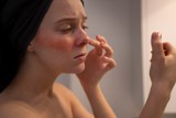 Zaczerwienienia na twarzy mogą być objawem choroby. Sprawdź, o czym mogą świadczyć plamy na twarzy, nagły rumieniec i zaczerwienienie skóry