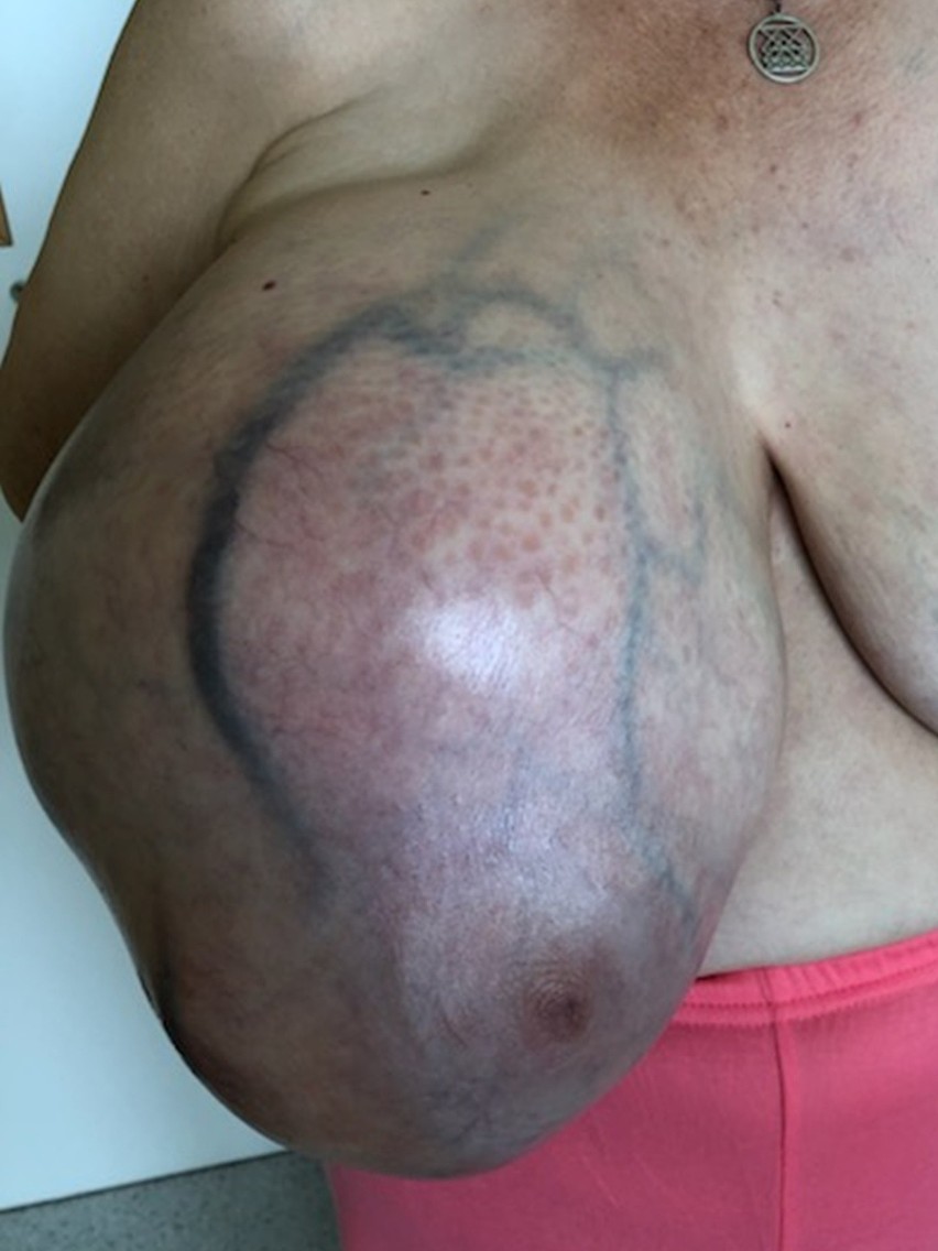Mieszkanka Jasła przez kilka lat nosiła w piersi 10-kilogramowego guza, bo... bała się operacji. Lekarz: "To ewenement"