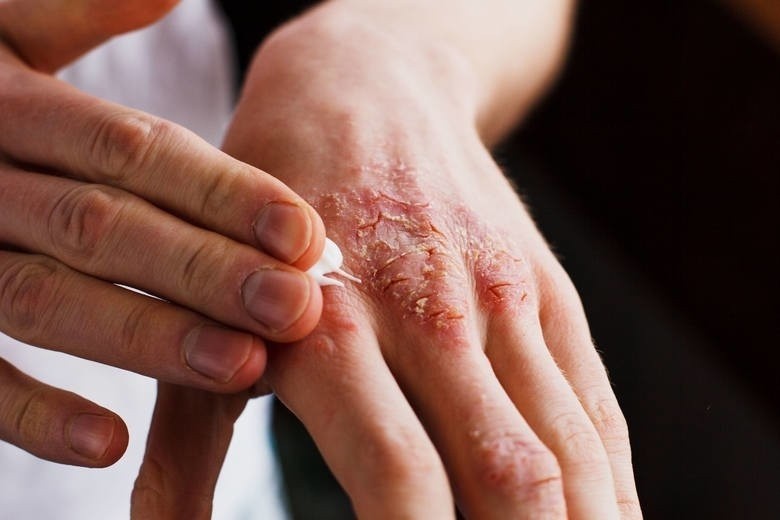 Choroby skóry dotykają wiele osób nie tylko w Toruniu i...