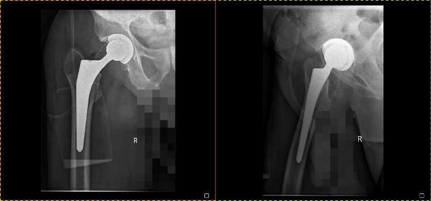 Tak wyglądają wszczepione protezy stawów biodrowych.