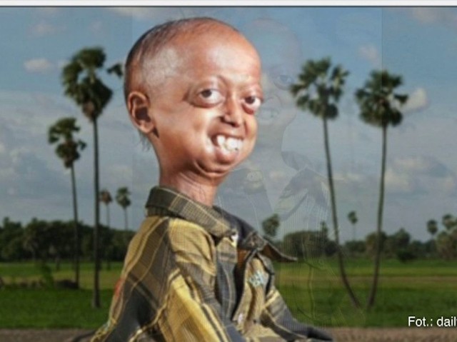Ali Hussain Khan cierpiący na progerię ma zaledwie 14 lat, choć wygląda na znacznie więcej