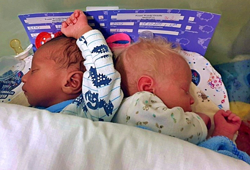 W łódzkim szpitalu urodziły się bliźniaki, z których jedno jest albinosem