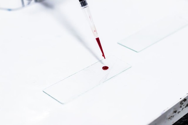 Hematokryt jest podstawowym badaniem diagnostycznym wchodzącym w skład morfologii krwi.