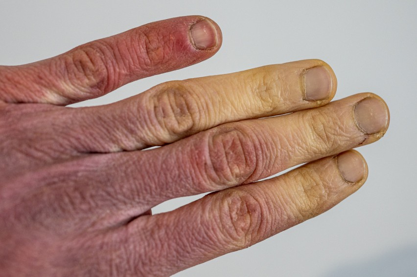 Po odmrożeniu dłoni może rozwinąć się choroba Raynauda, w...