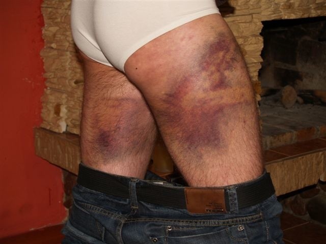 Kadzidło. Dwaj młodzi mężczyźni oskarżają policjantów o brutalne pobicie (zdjęcia) 