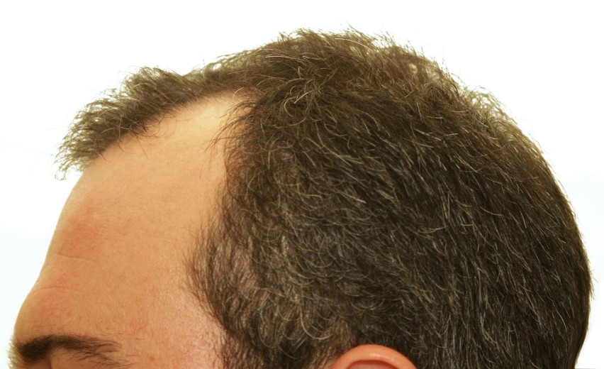 Przeszczep włosów jest ratunkiem dla osób dotkniętych...