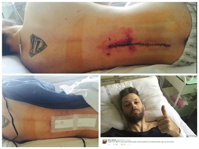 Rory Schlein na twitterze opublikował zdjęcia swoich pleców po operacji