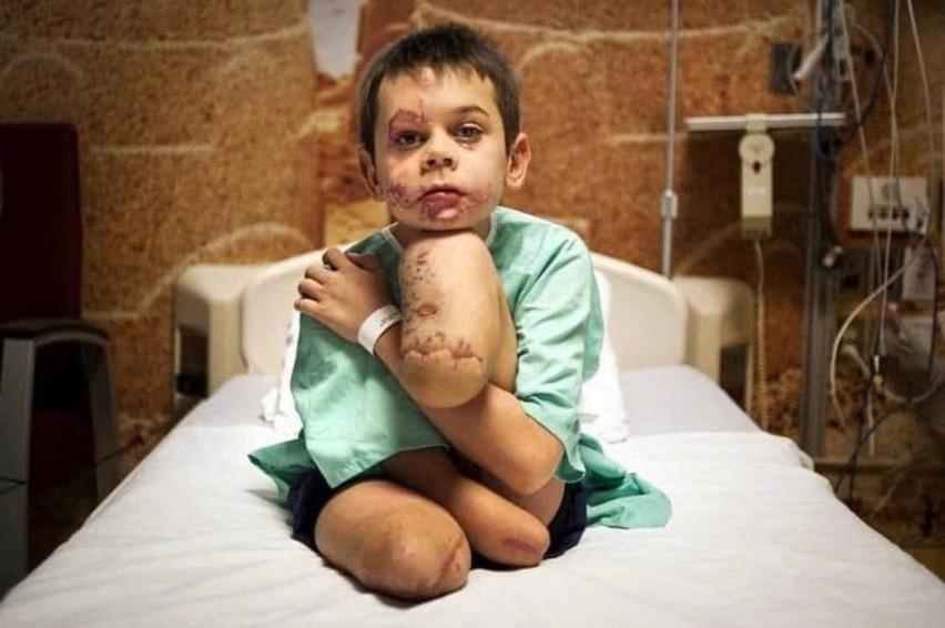 Chłopiec z amputowanymi nogami i prawą dłonią w szpitalu w...